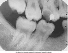 OCCLUSAL CARIES BUCCAL AND LINGUAL CARIES Haring &