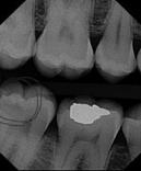 Dental Caries Dental Caries Radiograph of buccal or