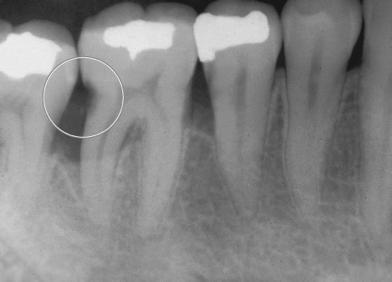 caries, and (4) cervical burnout The Role of Radiographs