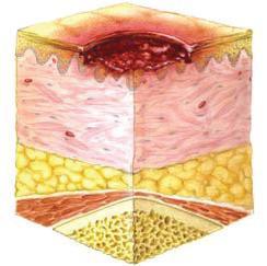 INTERNATIONAL NPUAP/EPUAP PRESSURE ULCER CLASSIFICATION SYSTEM (2014) A pressure ulcer is localized injury to the skin and/or underlying tissue usually over a bony prominence, as a result of