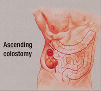 Colostomy