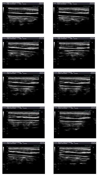 processing and segmentation method. 2.1 Images/Data Collections In this study, 200 carotid artery ultrasound images have been collected. Fig.