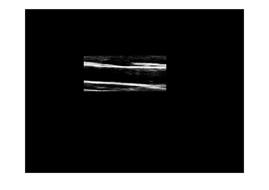 Change the RGB image to become Grayscale image Cropping Change the image to binary image (Black and white) Set threshold to detect carotid artery Remove the point that small than 600 pixels Fill up