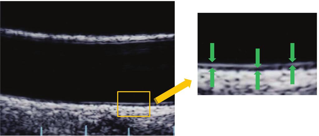 2 Carotid Artery Ultrasound Useful Method IMT MT IT B A Fig. 1. The double line pattern and separate measurement of carotid intima-media thickness.