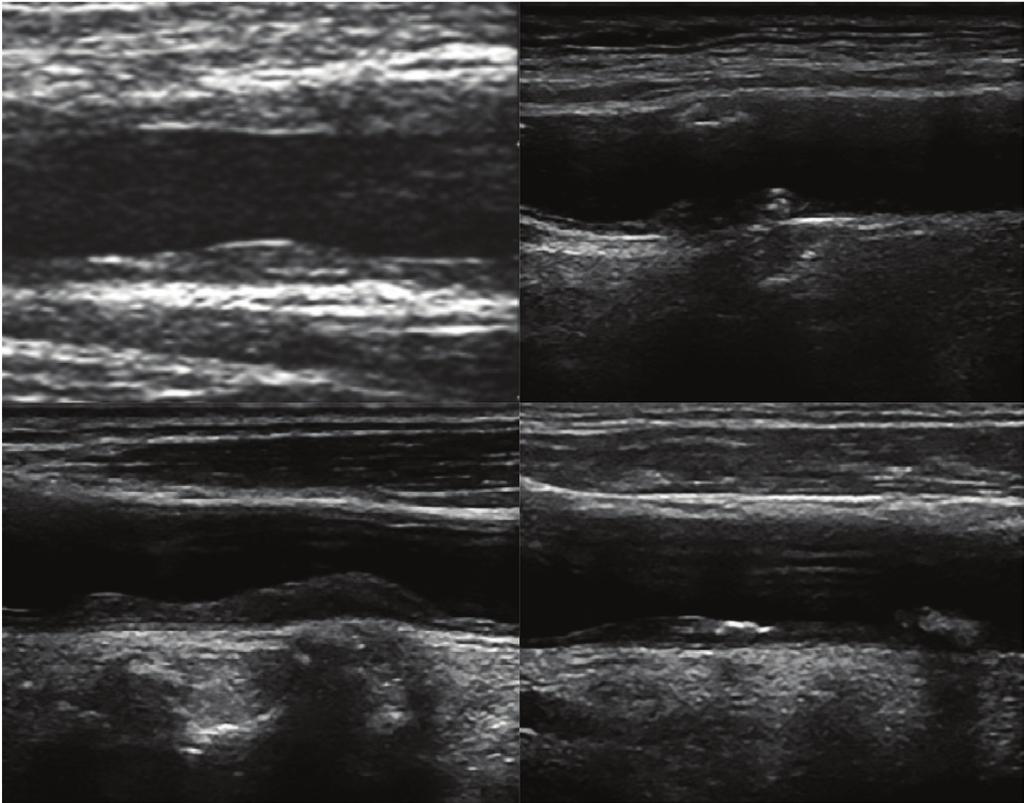 4 Carotid Artery Ultrasound Useful Method A B A B C Fig. 3. Variable tissue characterization of carotid plaque. (A) Single or focal plaque on normal common carotid intima-media thickness.