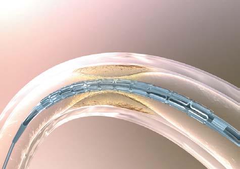 Limus Designed for Stent Applications Powerful Anti-proliferative and Anti-inflammatory