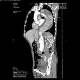 Less invasive thoracoabdominal aneurysm repair Operative technique
