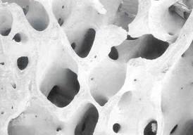 NIH Definition 2 Osteoporosis is defined as a skeletal disorder characterized by compromised bone strength predisposing a person to an increased risk of fracture.