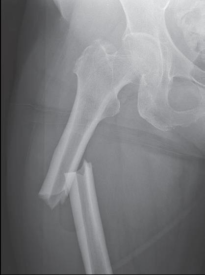 Atypical (Subtrochanteric) Femur Fractures ASBMR Task Force Definition 1 : Major Features* Anywhere along the femur No trauma or minimal trauma Transverse or short oblique configuration