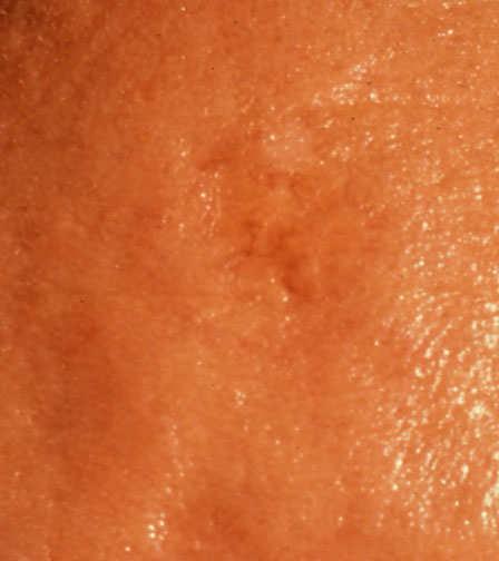 Basal Cell Carcinoma (BCC) Most common cancer in the US