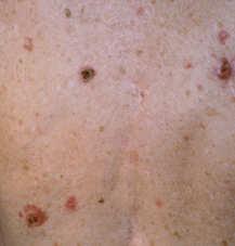 on shoulders, chest, back and arms Area of redness, often