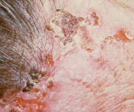 Features of Morpheaform BCC Most often on the face May look like a scar with poorly defined borders and a shiny, taut surface May ulcerate Usually more aggressive Often locally destructive Squamous