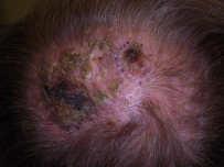 Recognizing the High-risk SCC Malignant Melanoma Multiple, rapid recurrences High risk locations: ear, lip Large size Aggressive growth Poor
