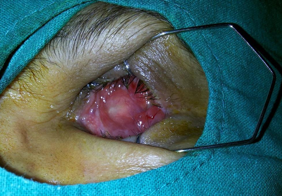 growth in the left eye observed for a month.