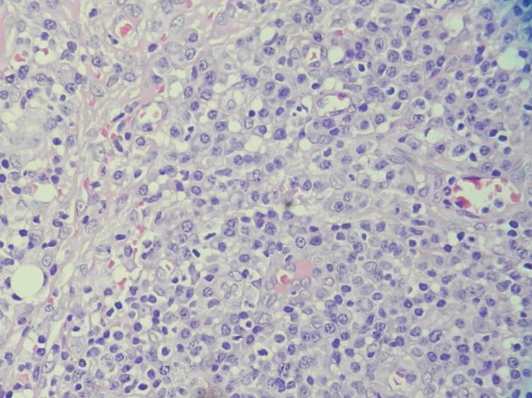 (H& E, 400X) Granulation tissue consists of proliferating Discussion connective tissue (fibroblasts and Pyogenic granulomas were fibrocytes) and newly formed capillary originally described by Poncet