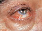 Dynamics of ocular allergy Acute Inflammation Chronic