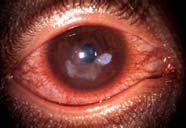 persistent forms of ocular allergy will progress with