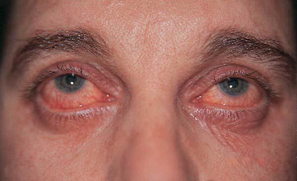 Seasonal (SAC) and Perennial (PAC) allergic conjunctivitis Are the most frequent forms Bilateral itching is the first ocular symptom, with tears and some burning Conjunctival hyperaemia and chemosis,