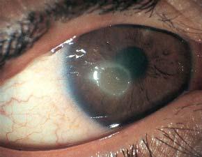 Vernal Keratoconjunctivitis (VKC) A rare form, typically seasonal (Spring / Summer) occurs in children and young adults (>males) 75% have also asthma, allergic rhinitis, or atopic eczema.