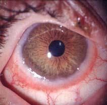 Vernal Keratoconjunctivitis (VKC) The limbal papillae with white apical gelatinous swellings are rich in