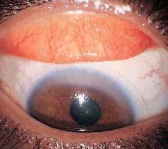 Giant Papillary conjunctivitis (GPC) It occurs due to allergy/ intolerance to contact lenses, their cleaning products or preservatives, corneal sutures or ocular prosthesis.