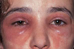 Contact Blepharoconjunctivitis (CBC) It is due to drugs (anaesthetics, atropine, antibiotics, antivirals, timolol.