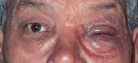 It leads to palpebral erythema and oedema, conjunctival follicles and, frequently, punctiform keratopathy L Delgado, J Palmares 2006 Contact blepharoconjunctivitis is