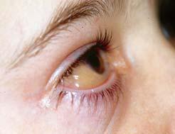 leading to conjunctival hperaemia and oedema