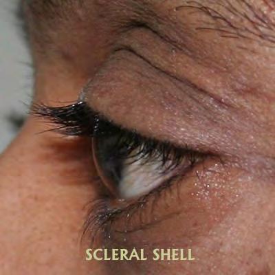 Scleral Shells Prosthetic Handling Ocular Prosthetics can easily be removed and