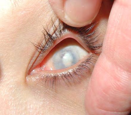 Eye Loss Conditions leading to a scleral shell Phthsical Eye Accident or Injury Retinal Detachment
