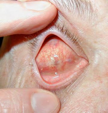 Evisceration Removal of the contents of the globe, leaving the sclera and extraocular muscles intact Indications: Endophthalmitis Improve cosmesis in a blind eye