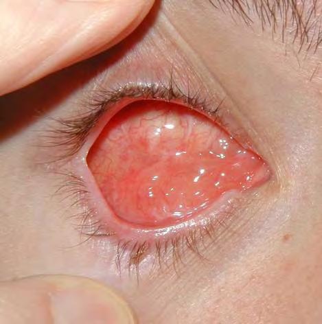 Eye Loss Conditions leading to an artificial eye Trauma Blind, Painful Eye Ruptured Globe Tumors / Ocular Melanoma