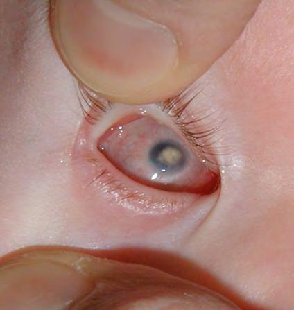 Eye Loss in Children Ideal Schedule Trauma First visit 1-2 weeks post-op Retinoblastoma Persistent Hyperplastic Examine socket, fit custom