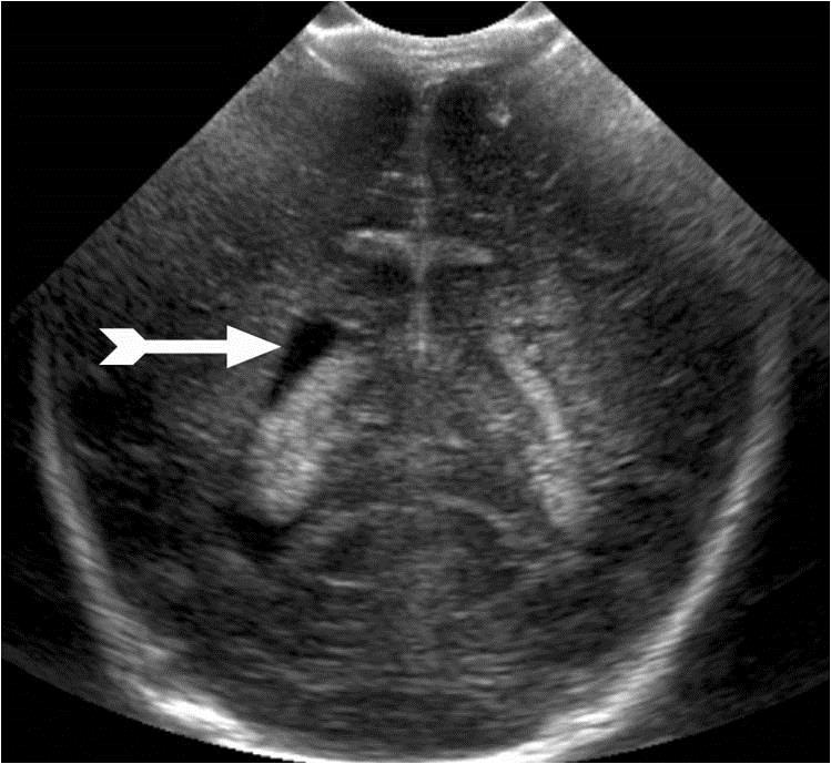 Normal Variants: Asymmetric Ventricles 20-40% infants Lateral