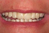 Advantages for the Dentist: Only one session required for placement Economical for you and your patient No free hand layering technique as with composite bonding Cerinate porcelain has greater