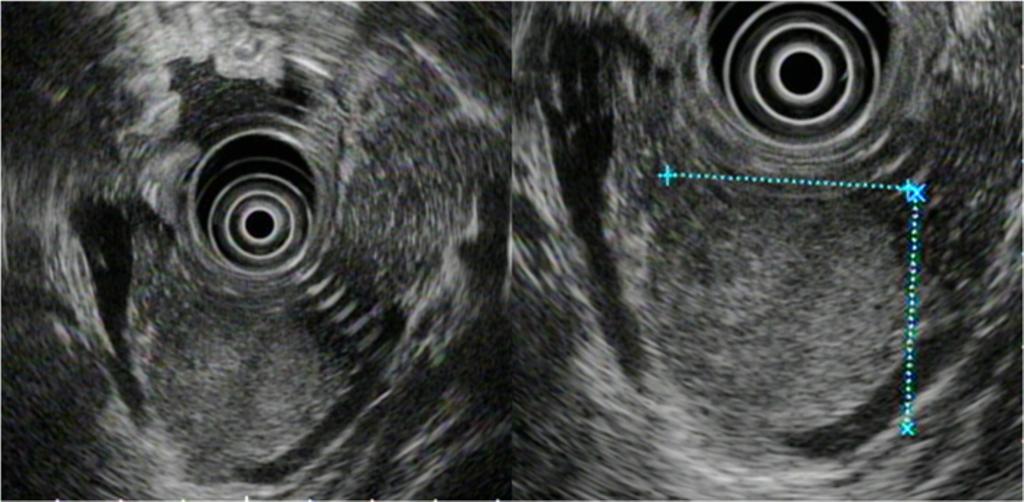 Fujii et al. Journal of Medical Case Reports 2014, 8:243 Page 3 of 5 Figure 2 Endoscopic ultrasound. These two images show a low echoic mass of 35mm diameter in the pancreatic tail.