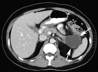 Figure 3: Pseudocyst. Abdominal CT scan of a simple, thin-walled pseudocyst indicated by white arrows.
