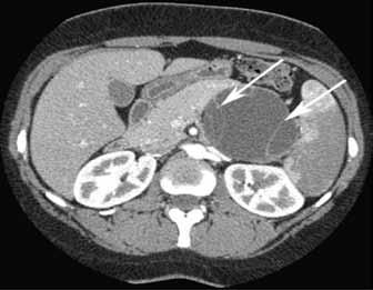 Figure 3: Pseudocyst. Abdominal CT scan of a simple, thin-walled pseudocyst indicated by white arrows. Figure 5: Mucinous lesion.