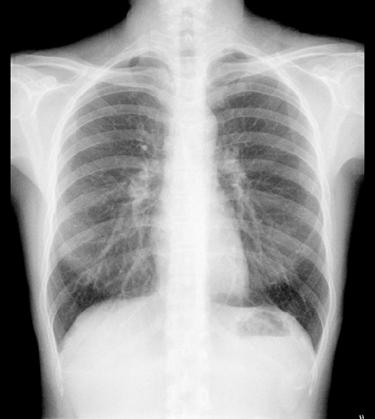 Image CXR Normal lung field.