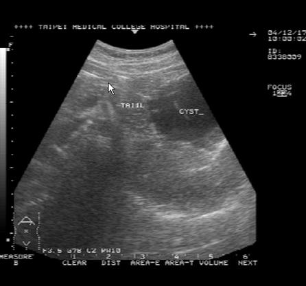 Image Abdominal Sonography There was a 8.7x8.