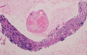 SOLID LESIONS/NEOPLASMS CHRONIC PANCREATITIS FNA performed to exclude malignancy rather that diagnose chronic