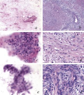 AUTOIMMUNE PANCREATITIS (AIP) Definitive diagnosis challenging if not impossible on EUS-FNA Improved prospects of AIP Dx with newer EUS needles Cytologic Features More stromal fragments Inflammatory