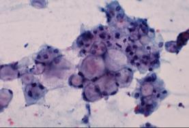 -Cells with mucin vacuoles -Careful