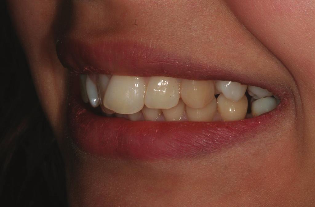 Orthodontics Figure 13: Figure 14: Figure 15: Figure 16: practice in the UK, was one of the first dentists I showed how to use the Aligner and since then has helped to develop techniques to