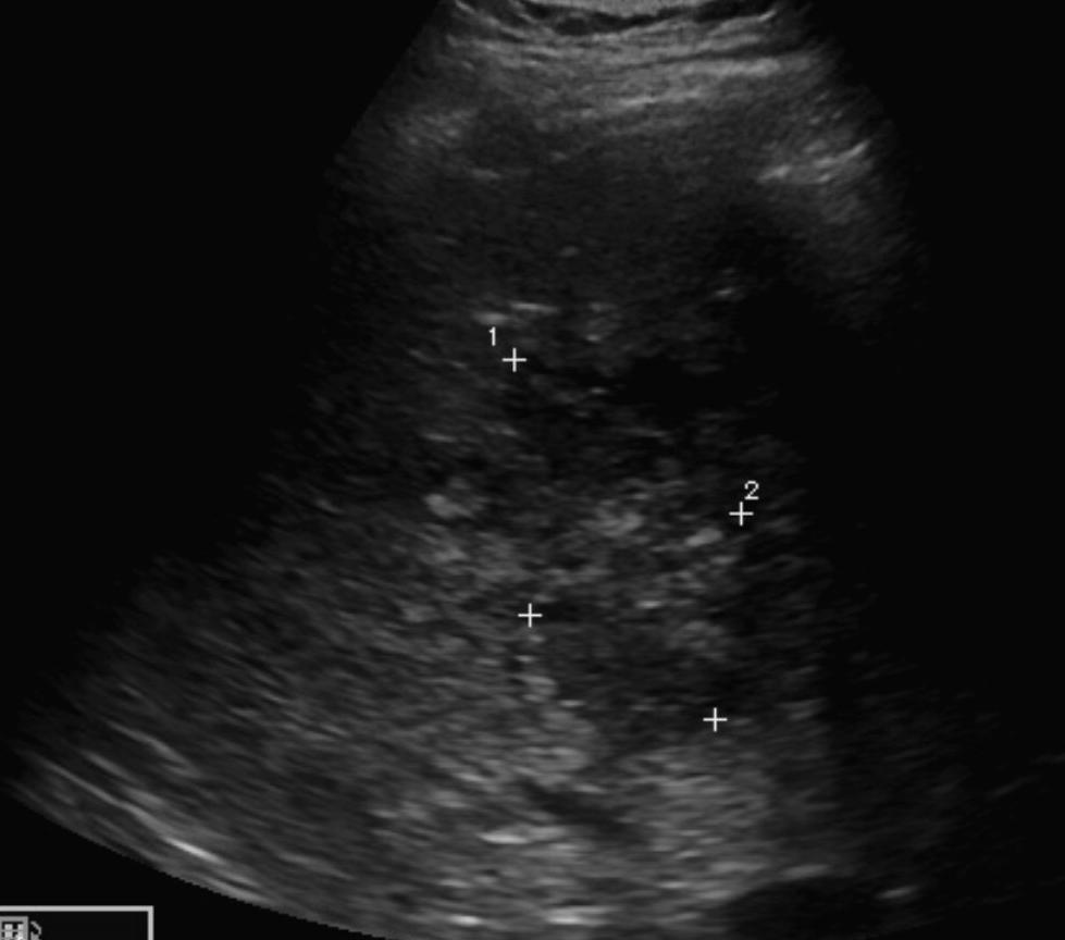 Liver abscess US findings Hypoechoic lesion with well defined mildly echoic rim Posterior acoustic