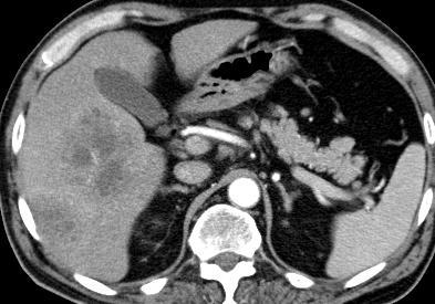 Liver abscess CT findings