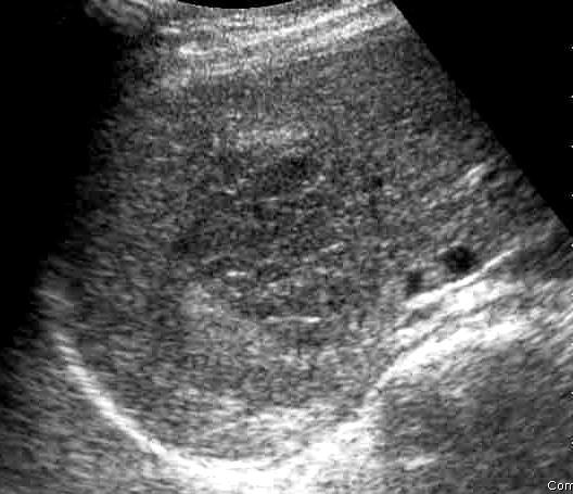 Hepatocellular carcinoma Ultrasound o Lower sensitivity and specificity than CT or MR in diagnosing HCC