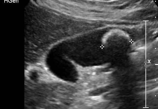 Ultrasound Gallstone Imaging tool of choice, accuracy 96% Highly