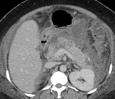 Acute pancreatitis CT findings Focal or diffuse pancreatic enlargement