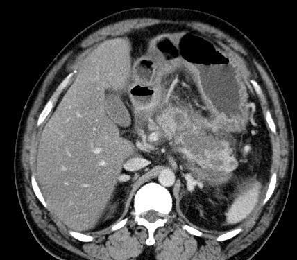 of fluid collection, abscess and pseudocyst Infiltration of peripancreatic